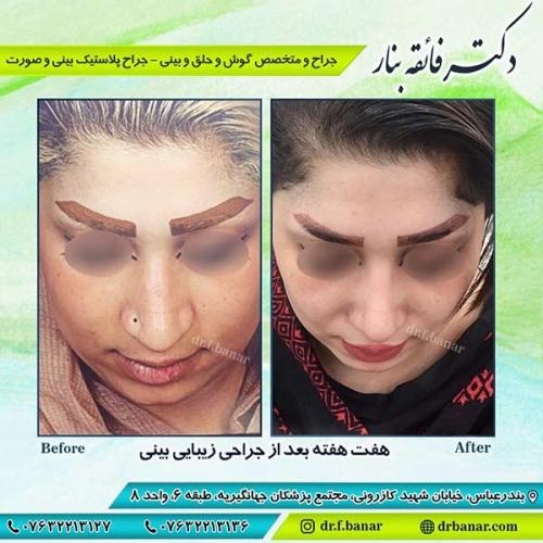 جراحی-بینی-بندر-عباس-4-27