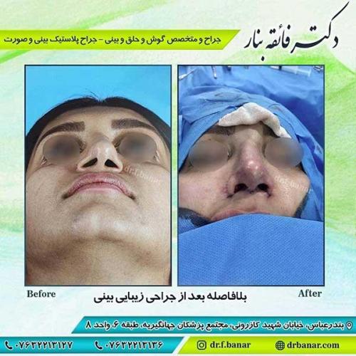جراحی-بینی-بندر-عباس-4-30
