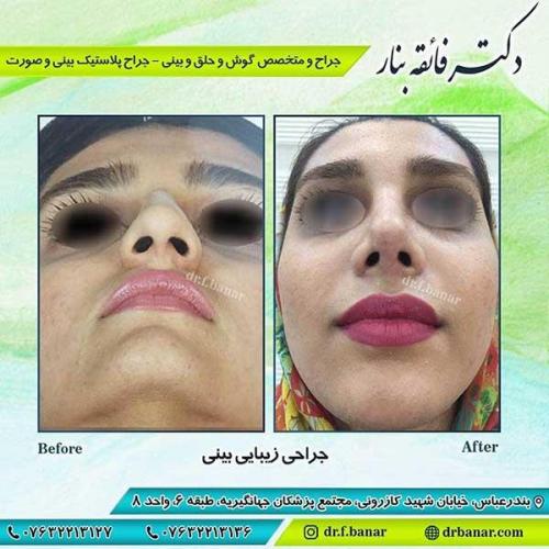 جراحی-بینی-بندر-عباس-4-35