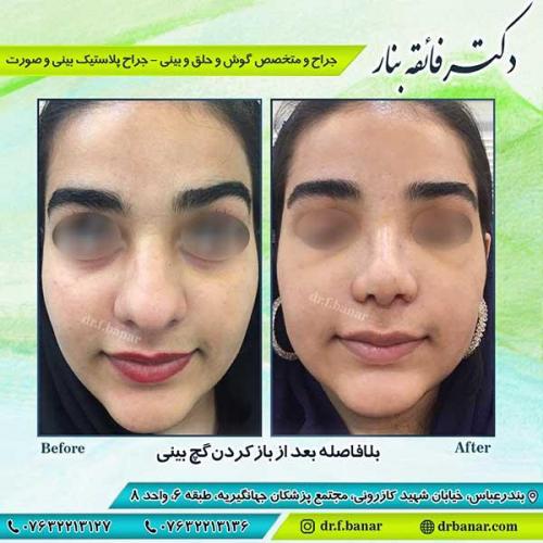 جراحی-بینی-بندر-عباس-4-36