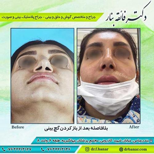 جراحی-بینی-بندر-عباس-4-37