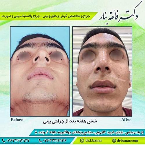 جراحی-بینی-بندر-عباس-4-38