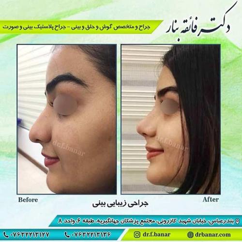 جراحی-بینی-بندر-عباس-4-40