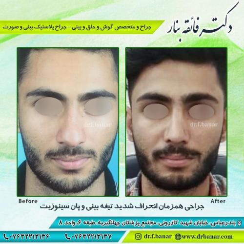 جراحی-بینی-بندر-عباس-43