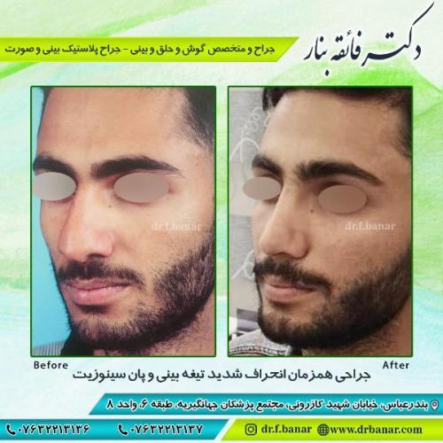 جراحی-بینی-بندر-عباس-44