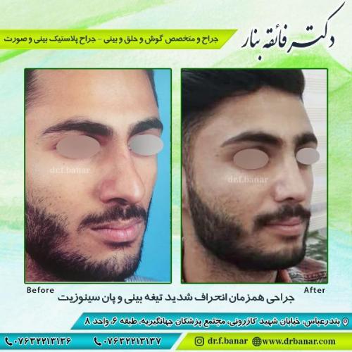 جراحی-بینی-بندر-عباس-45