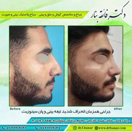 جراحی-بینی-بندر-عباس-46