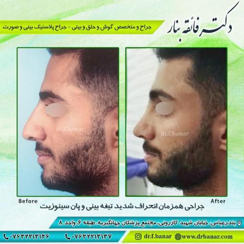 جراحی-بینی-بندر-عباس-47