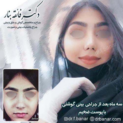 جراحی-بینی-بندر-عباس-48