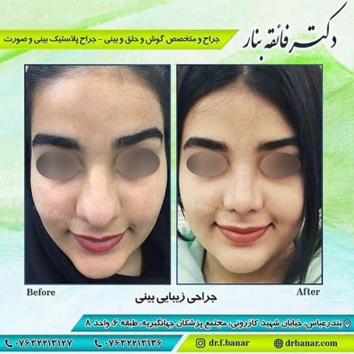 جراحی-بینی-بندر-عباس-5-40
