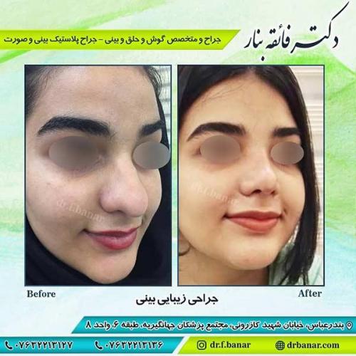 جراحی-بینی-بندر-عباس-6-40