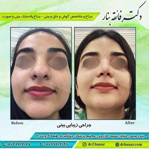 جراحی-بینی-بندر-عباس-7-40