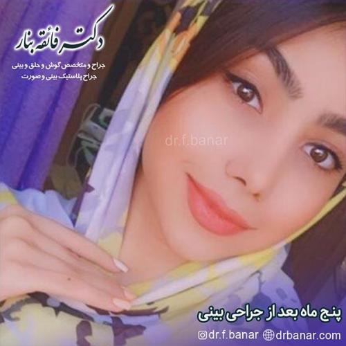 جراحی-بینی-بندرعباس-51