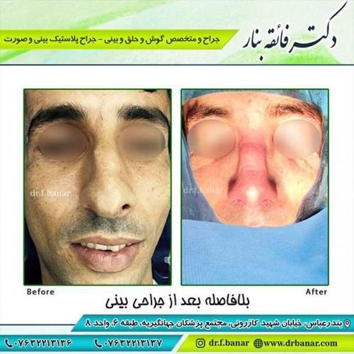 جراحی-بینی-بندرعباس-52