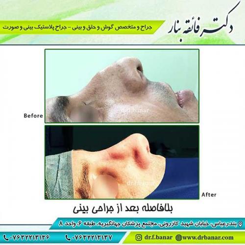 جراحی-بینی-بندرعباس-53