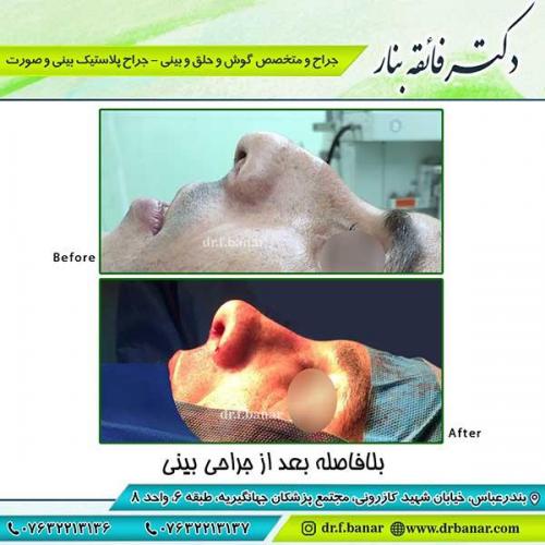 جراحی-بینی-بندرعباس-54