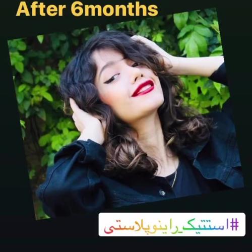 جراحی-بینی-در-بندر-عباس-245