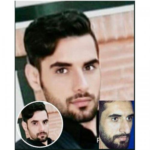 جراحی-بینی-در-بندرعباس-208