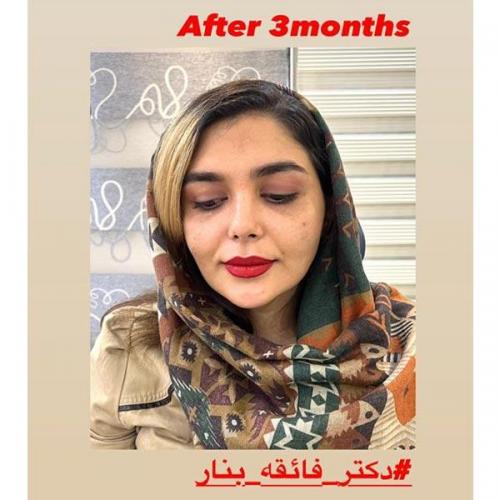 جراحی-بینی-در-بندرعباس-210