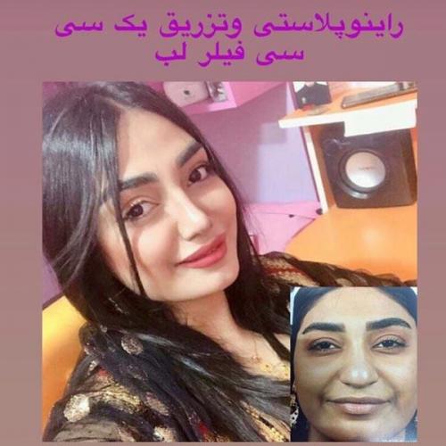 جراحی-بینی-در-بندرعباس-213