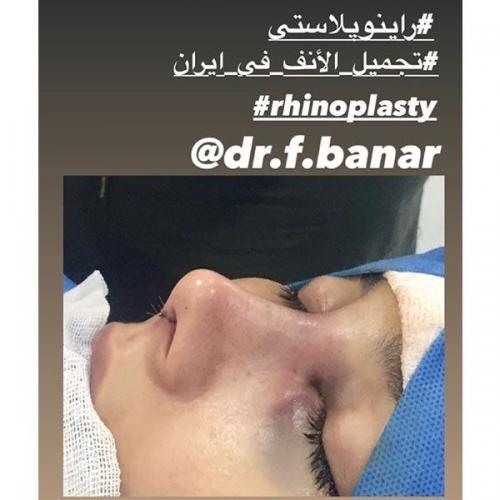 جراحی-بینی-در-بندرعباس-215 (1)