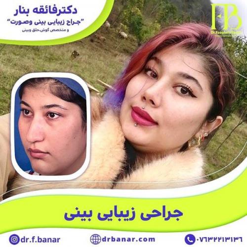 جراحی-بینی-در-بندرعباس-217 