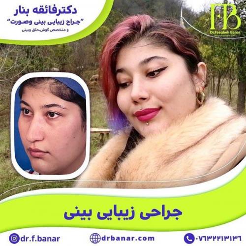 جراحی-بینی-در-بندرعباس-218 