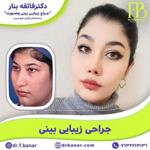 جراحی-بینی-در-بندرعباس-219 