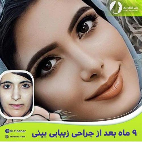جراحی-بینی-در-بندرعباس204