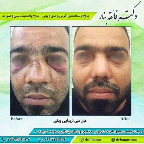جراحی-زیبایی-بینی-15