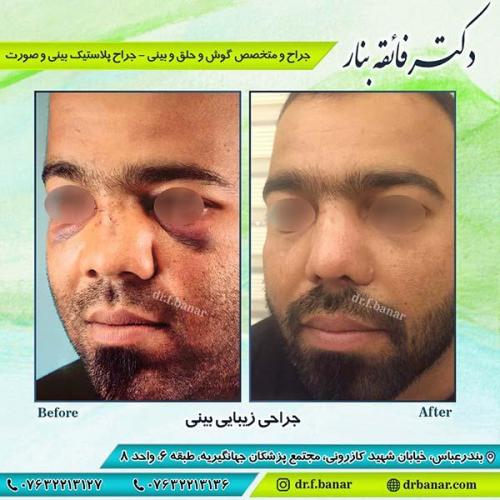جراحی-زیبایی-بینی-16