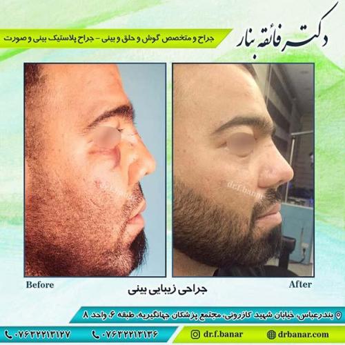 جراحی-زیبایی-بینی-17