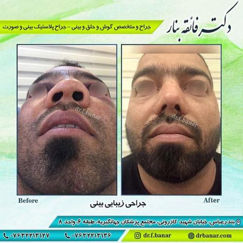 جراحی-زیبایی-بینی-18
