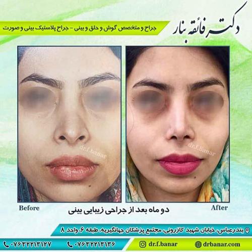 جراحی-زیبایی-بینی-19