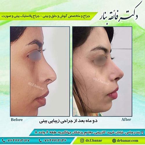 جراحی-زیبایی-بینی-20