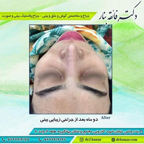 جراحی-زیبایی-بینی-22