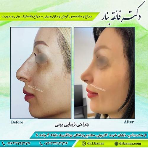 جراحی-زیبایی-بینی-23