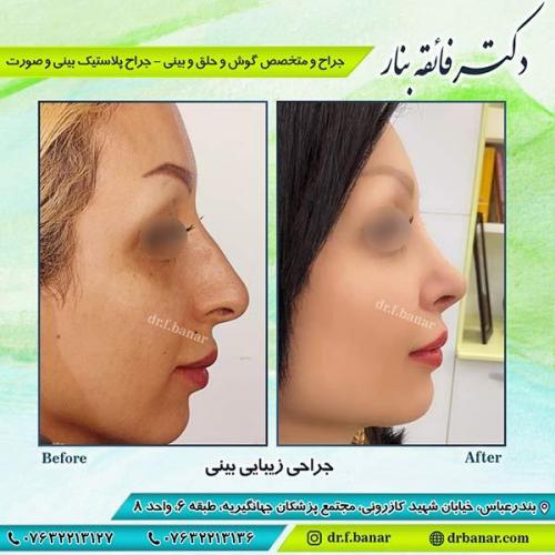 جراحی-زیبایی-بینی-24