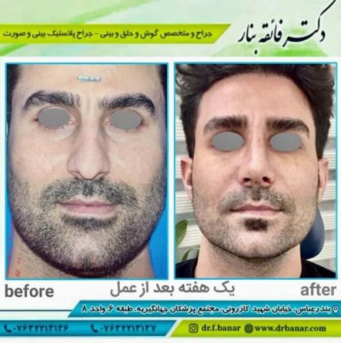 جراحی بینی در بندرعباس 153