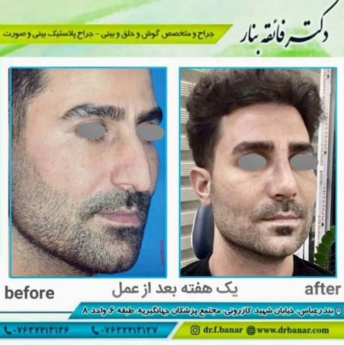 جراحی بینی در بندرعباس 154