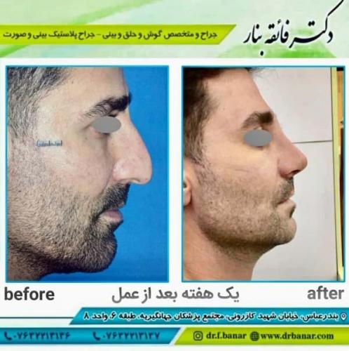 جراحی بینی در بندرعباس 155