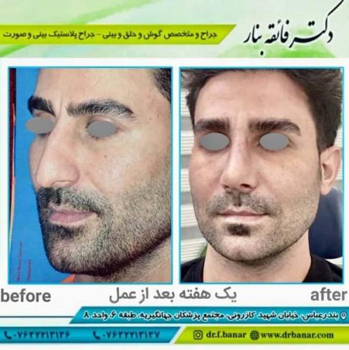جراحی بینی در بندرعباس 156