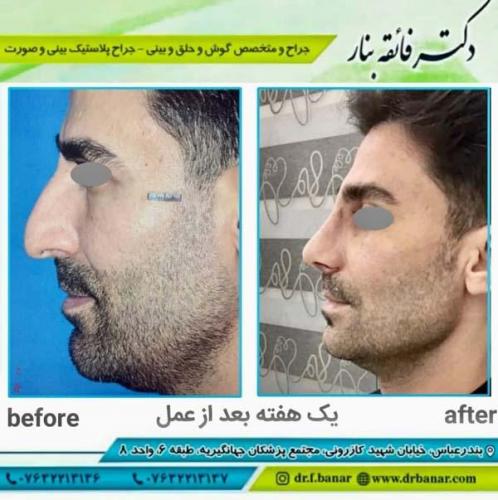 جراحی بینی در بندرعباس 157