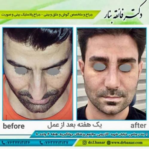 جراحی بینی در بندرعباس 158