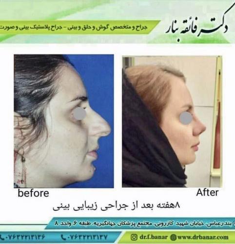جراحی بینی در بندرعباس 159