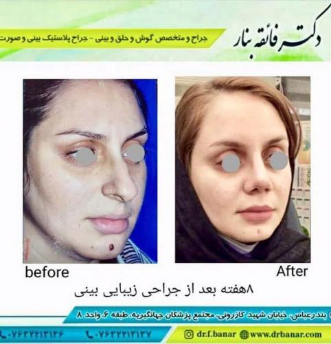 جراحی بینی در بندرعباس 160