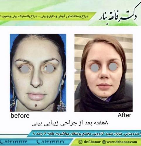 جراحی بینی در بندرعباس 161