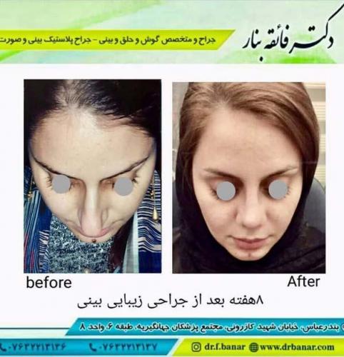 جراحی بینی در بندرعباس 162