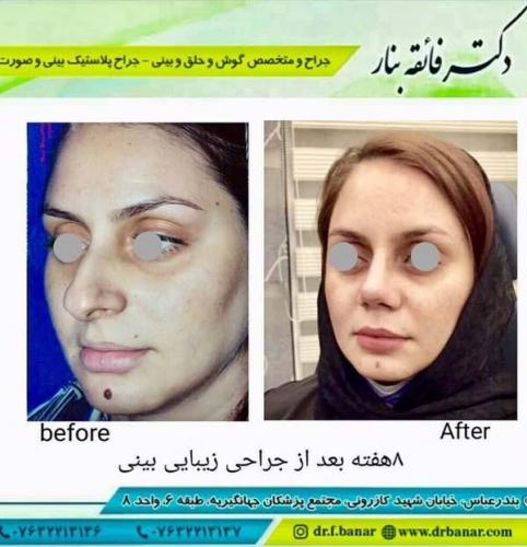 جراحی بینی در بندرعباس 163