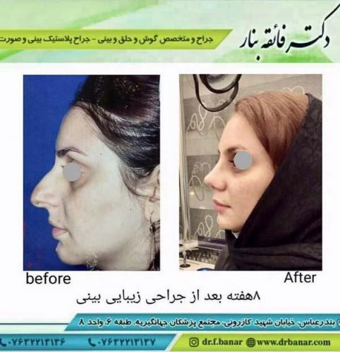 جراحی بینی در بندرعباس 164